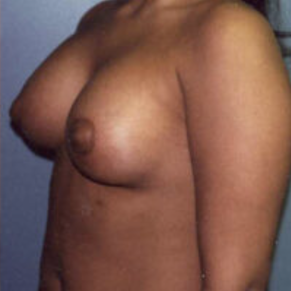 Tubular Breasts Before and After photo by Douglas Hargrave, MD of The Plastic Surgery Group in Albany, NY