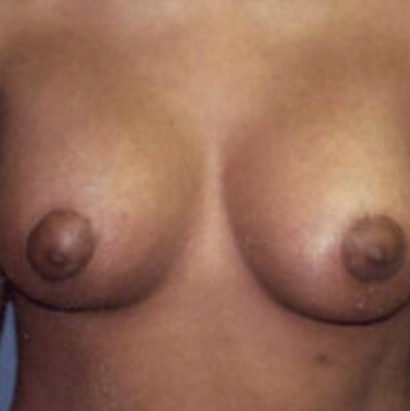 Tubular Breasts Before and After photo by Douglas Hargrave, MD of The Plastic Surgery Group in Albany, NY