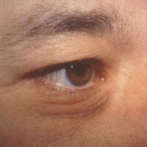 Eyelid Surgery Before and After photo by Douglas Hargrave, MD of The Plastic Surgery Group in Albany, NY Eyelid Surgery Before and After photo by Douglas Hargrave, MD of The Plastic Surgery Group in Albany, NY