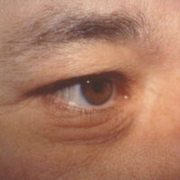 Eyelid Surgery Before and After photo by Douglas Hargrave, MD of The Plastic Surgery Group in Albany, NY