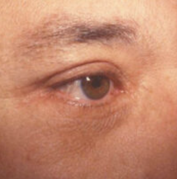 Eyelid Surgery Before and After photo by Douglas Hargrave, MD of The Plastic Surgery Group in Albany, NY Eyelid Surgery Before and After photo by Douglas Hargrave, MD of The Plastic Surgery Group in Albany, NY