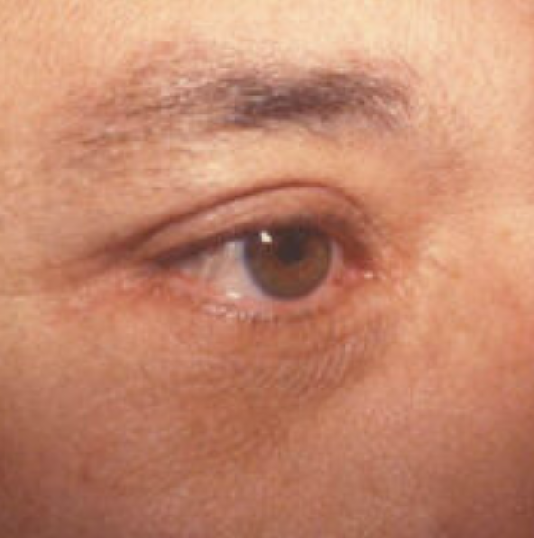 Eyelid Surgery Before and After photo by Douglas Hargrave, MD of The Plastic Surgery Group in Albany, NY