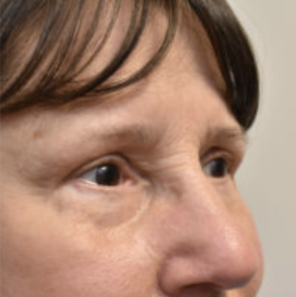 Eyelid Surgery Before and After photo by Susan Gannon, MD of The Plastic Surgery Group in Albany, NY Eyelid Surgery Before and After photo by Susan Gannon, MD of The Plastic Surgery Group in Albany, NY