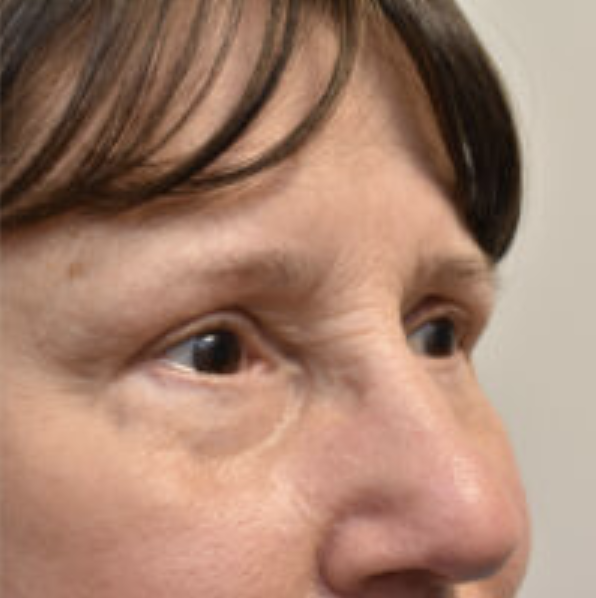 Eyelid Surgery Before and After photo by Susan Gannon, MD of The Plastic Surgery Group in Albany, NY