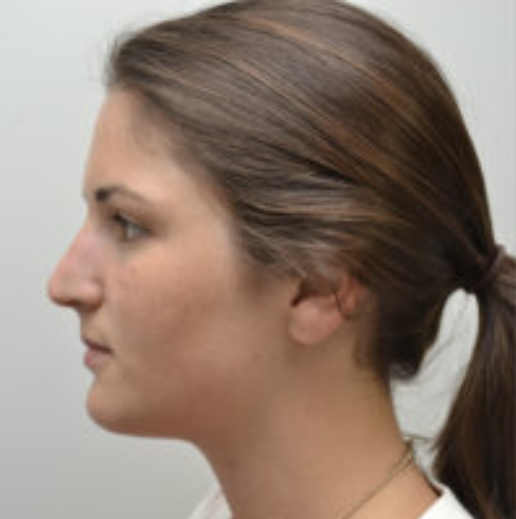 Rhinoplasty Before and After photo by Douglas Hargrave, MD of The Plastic Surgery Group in Albany, NY