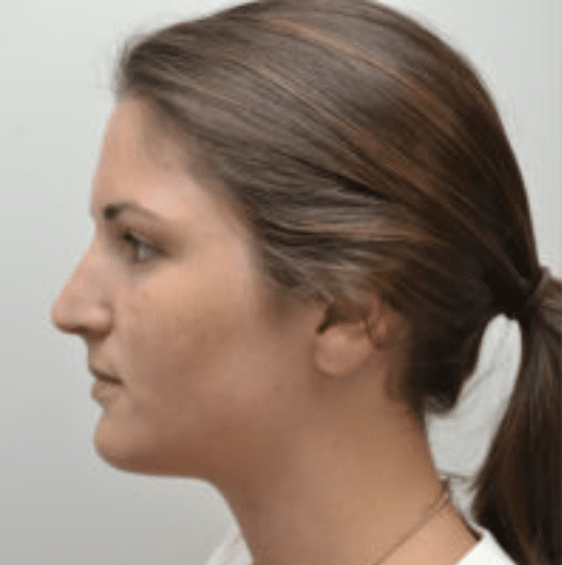 Rhinoplasty Before and After photo by Douglas Hargrave, MD of The Plastic Surgery Group in Albany, NY Rhinoplasty Before and After photo by Douglas Hargrave, MD of The Plastic Surgery Group in Albany, NY