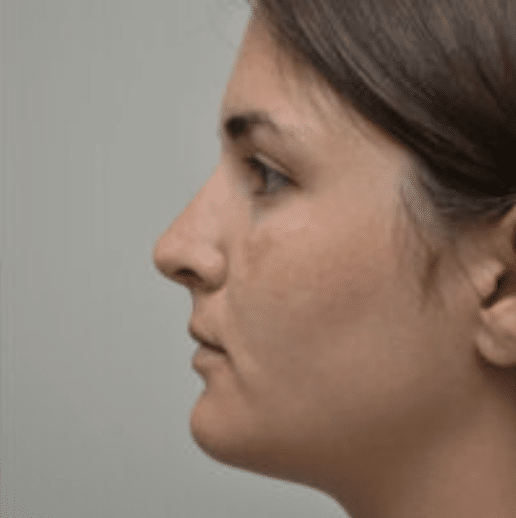 Rhinoplasty Before and After photo by Douglas Hargrave, MD of The Plastic Surgery Group in Albany, NY Rhinoplasty Before and After photo by Douglas Hargrave, MD of The Plastic Surgery Group in Albany, NY