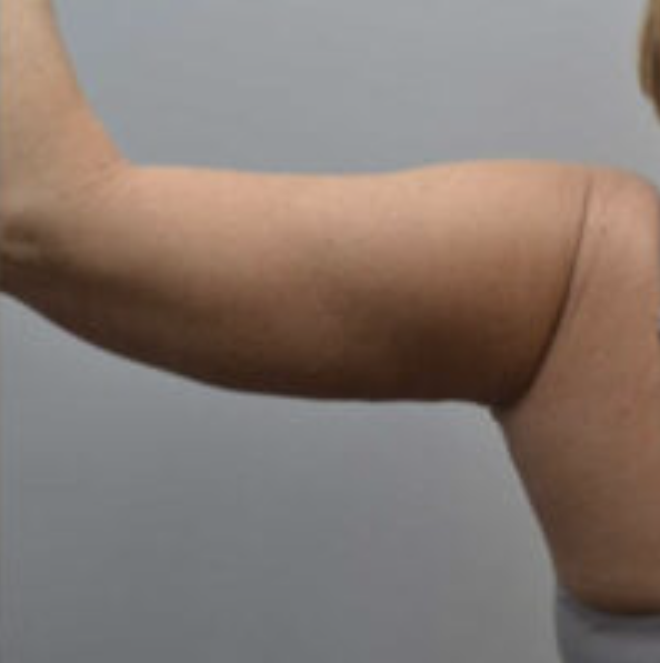 Arm Lift Before and After photo by Douglas Hargrave, MD of The Plastic Surgery Group in Albany, NY