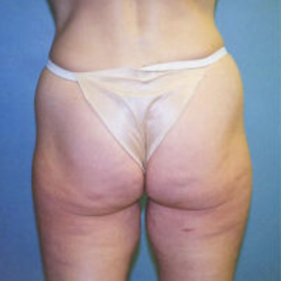 Buttock Lift Before and After photo by Douglas Hargrave, MD of The Plastic Surgery Group in Albany, NY