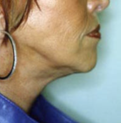 Facelift Before and After photo by Douglas Hargrave, MD of The Plastic Surgery Group in Albany, NY