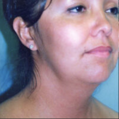 Neck Lift Before and After photo by Douglas Hargrave, MD of The Plastic Surgery Group in Albany, NY
