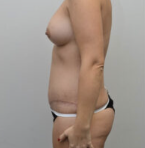Tummy Tuck Before and After photo by Douglas Hargrave, MD of The Plastic Surgery Group in Albany, NY Tummy Tuck Before and After photo by Douglas Hargrave, MD of The Plastic Surgery Group in Albany, NY