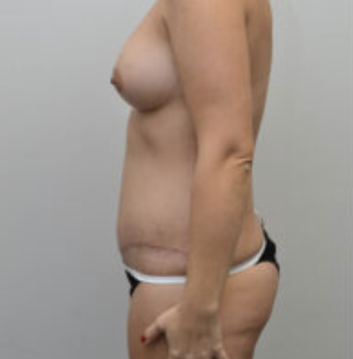 Tummy Tuck Before and After photo by Douglas Hargrave, MD of The Plastic Surgery Group in Albany, NY