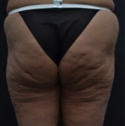 Thigh Lift Before and After photo by Douglas Hargrave, MD of The Plastic Surgery Group in Albany, NY