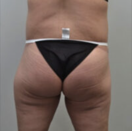 Thigh Lift Before and After photo by Douglas Hargrave, MD of The Plastic Surgery Group in Albany, NY