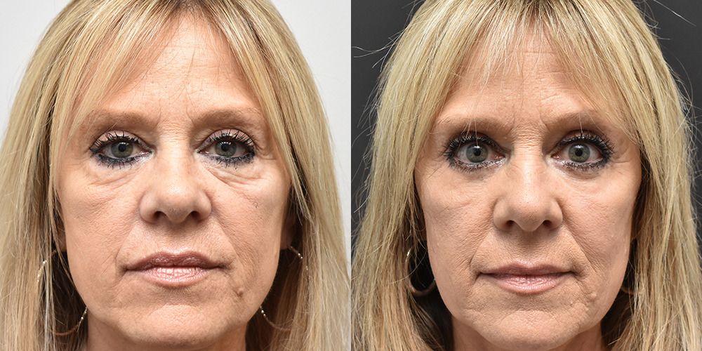 Eyelid Surgery Before and After photo by Douglas Hargrave, MD of The Plastic Surgery Group in Albany, NY
