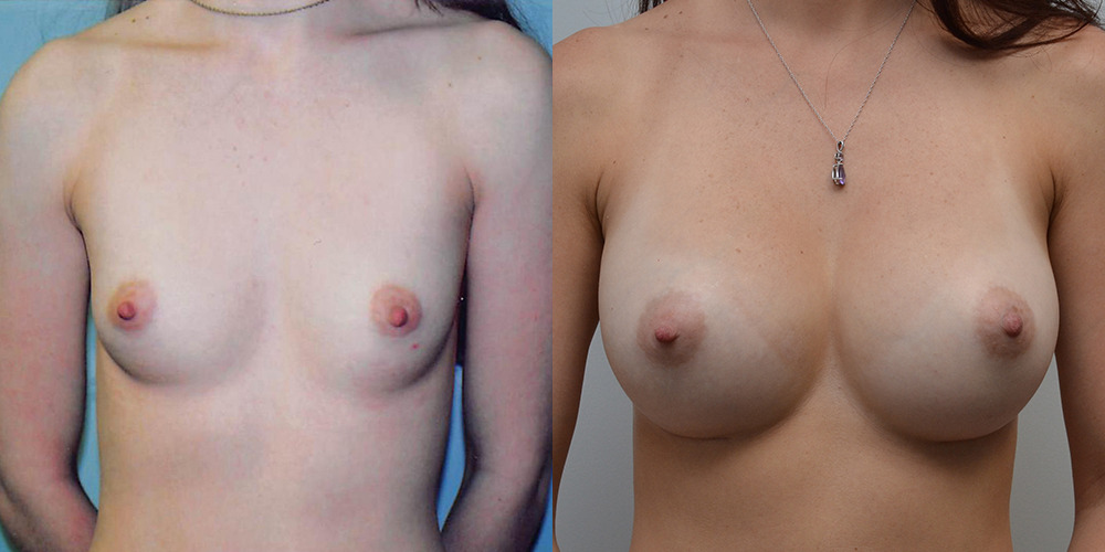 Breast Augmentation Before and After photo by Douglas Hargrave, MD of The Plastic Surgery Group in Albany, NY