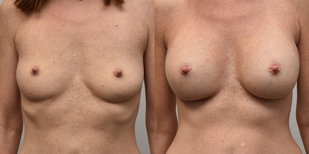 Breast Augmentation Before and After photo by Douglas Hargrave, MD of The Plastic Surgery Group in Albany, NY