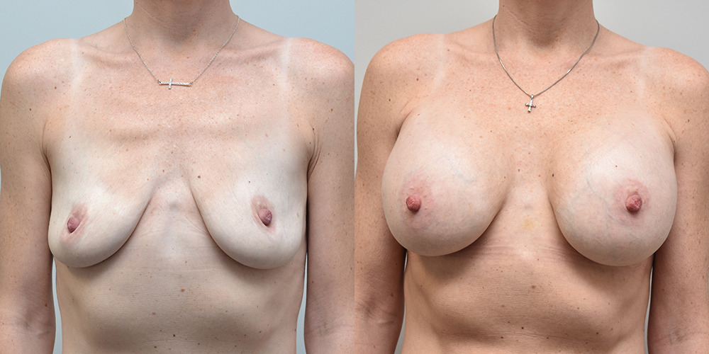 Breast Augmentation with Lift Before and After photo by Douglas Hargrave, MD of The Plastic Surgery Group in Albany, NY
