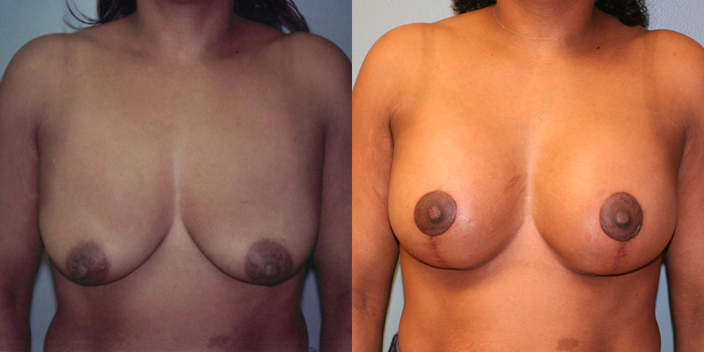 Breast Augmentation with Lift Before and After photo by Douglas Hargrave, MD of The Plastic Surgery Group in Albany, NY