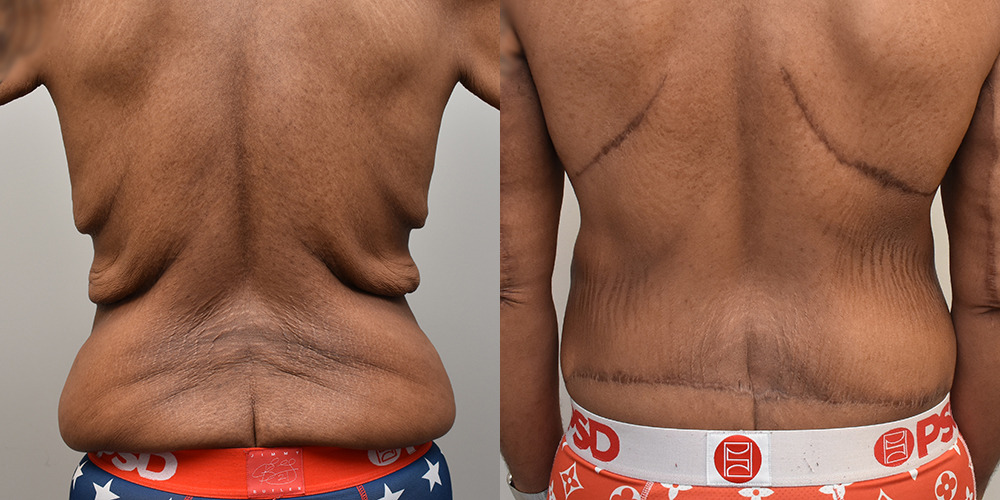 Body Lift Before and After photo by Douglas Hargrave, MD of The Plastic Surgery Group in Albany, NY