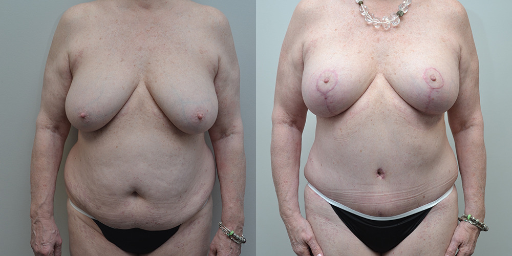 Mommy Makeover Before and After photo by Douglas Hargrave, MD of The Plastic Surgery Group in Albany, NY