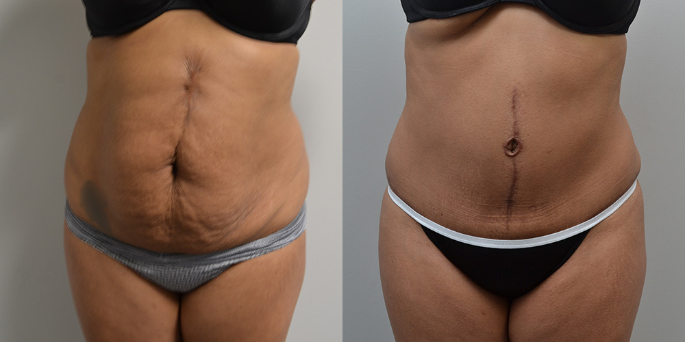 Tummy Tuck Before and After photo by Douglas Hargrave, MD of The Plastic Surgery Group in Albany, NY