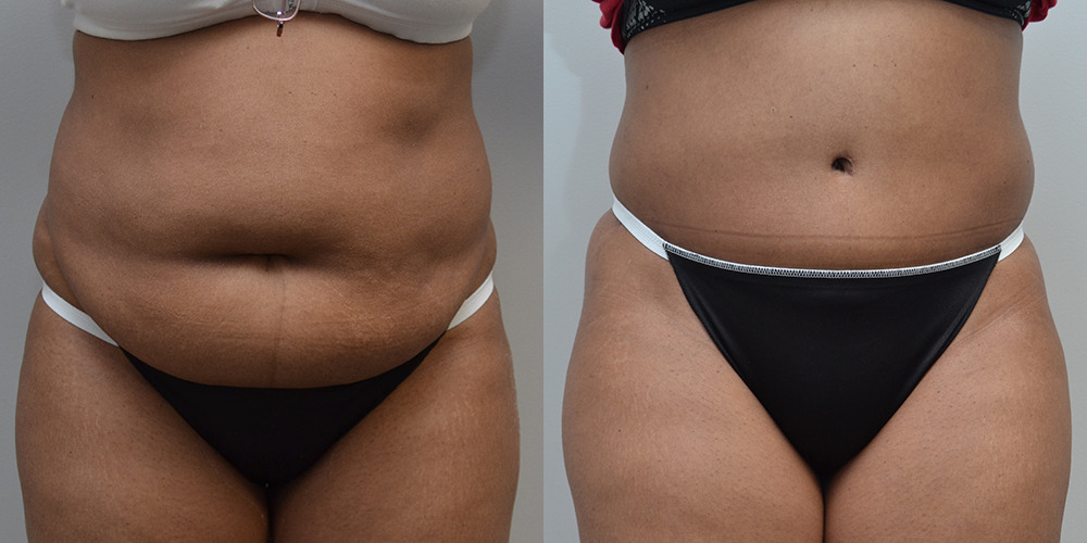 Tummy Tuck Before and After photo by Douglas Hargrave, MD of The Plastic Surgery Group in Albany, NY