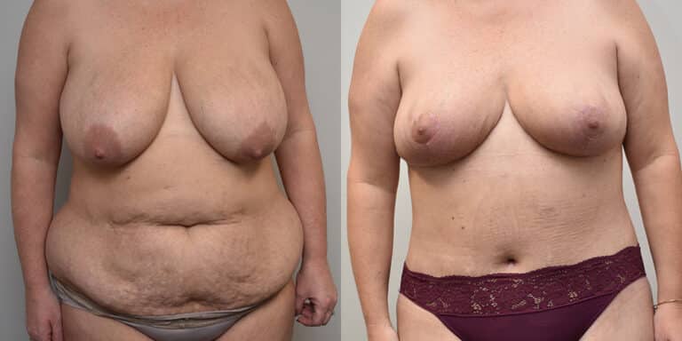 Tummy Tuck Before and After photo by Douglas Hargrave, MD of The Plastic Surgery Group in Albany, NY Tummy Tuck Before and After photo by Douglas Hargrave, MD of The Plastic Surgery Group in Albany, NY