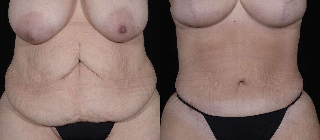 Tummy Tuck Before and After Photo by Craig Fournier MD in Albany, NY