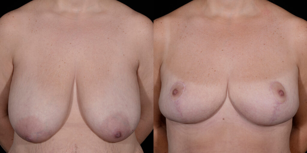 Breast Reduction by Craig Fournier, MD