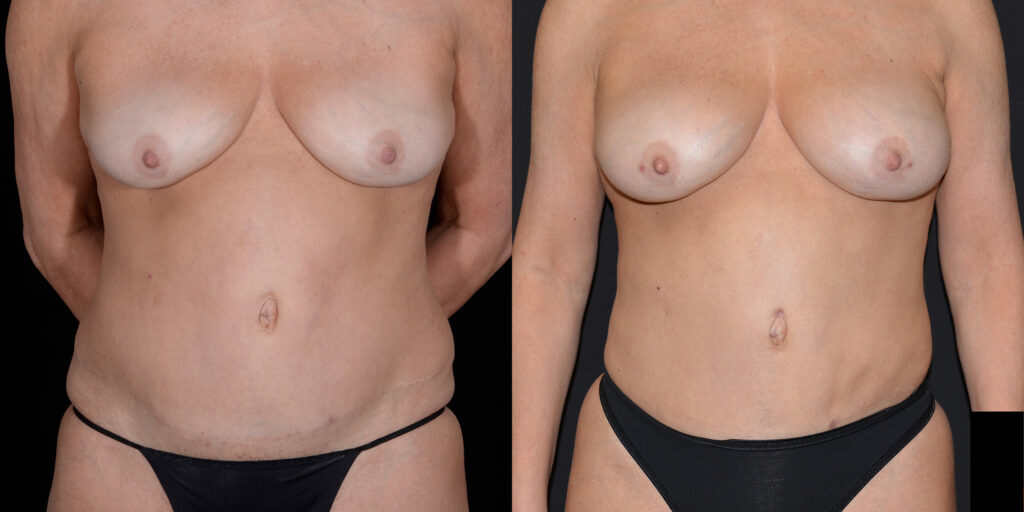 Liposuction by Craig Fournier, MD