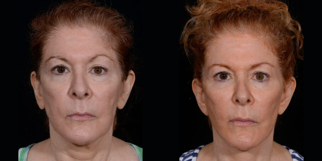 Face Lift by Craig Fournier, MD