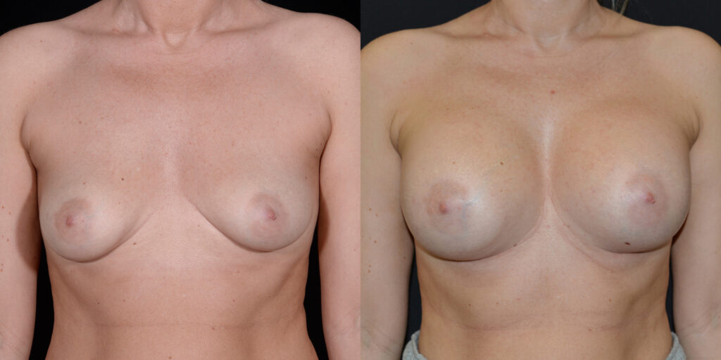 Breast Augmentation by Craig Fournier, MD