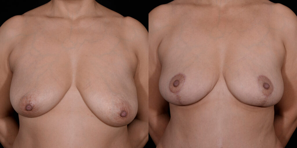 Breast Lift by Craig Fournier, MD