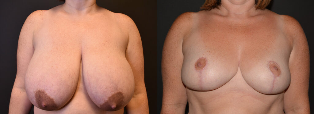 Breast Reduction Before and After Photo by Craig Fournier MD in Albany, NY