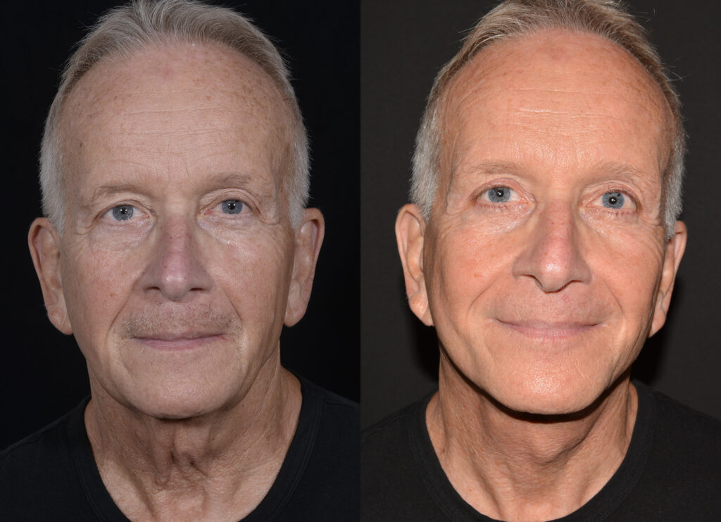 Facelift Before and After Photo by Craig Fournier MD in Albany, NY