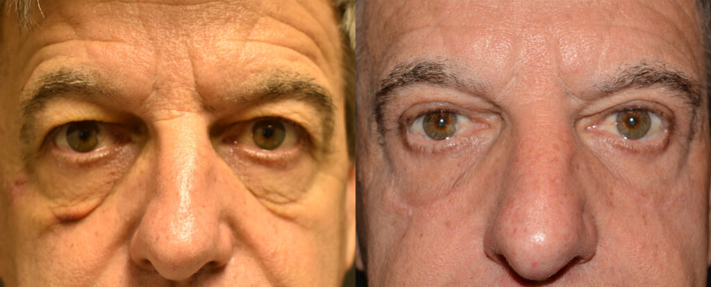 Eyelid Surgery Before and After Photo by Craig Fournier MD in Albany, NY