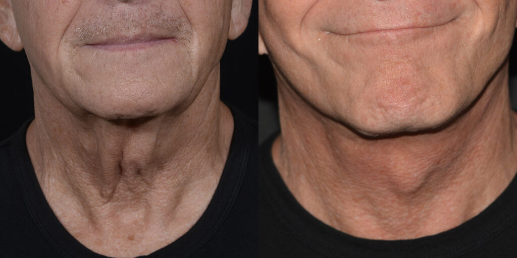 Neck Lift Before and After Photo by Craig Fournier MD in Albany, NY