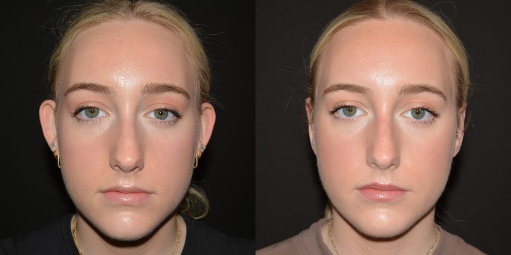 Otoplasty Before and After Photo by Craig Fournier MD in Albany, NY