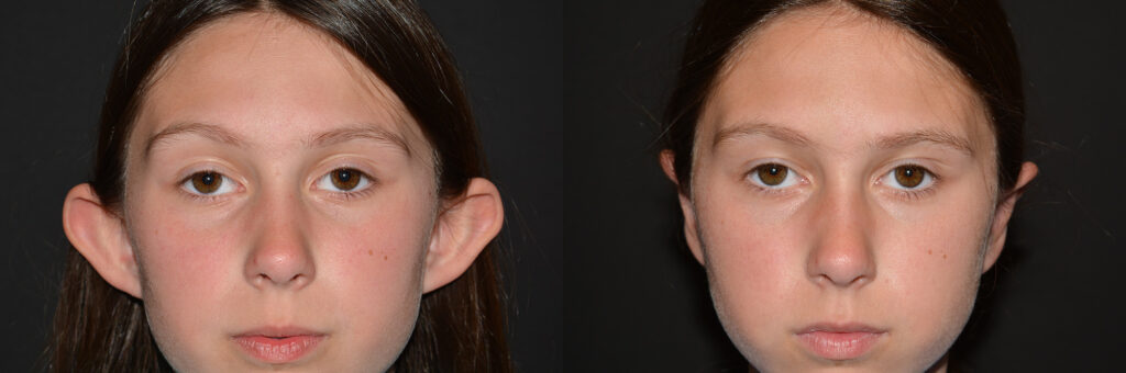 Otoplasty Before and After Photo by Craig Fournier MD in Albany, NY