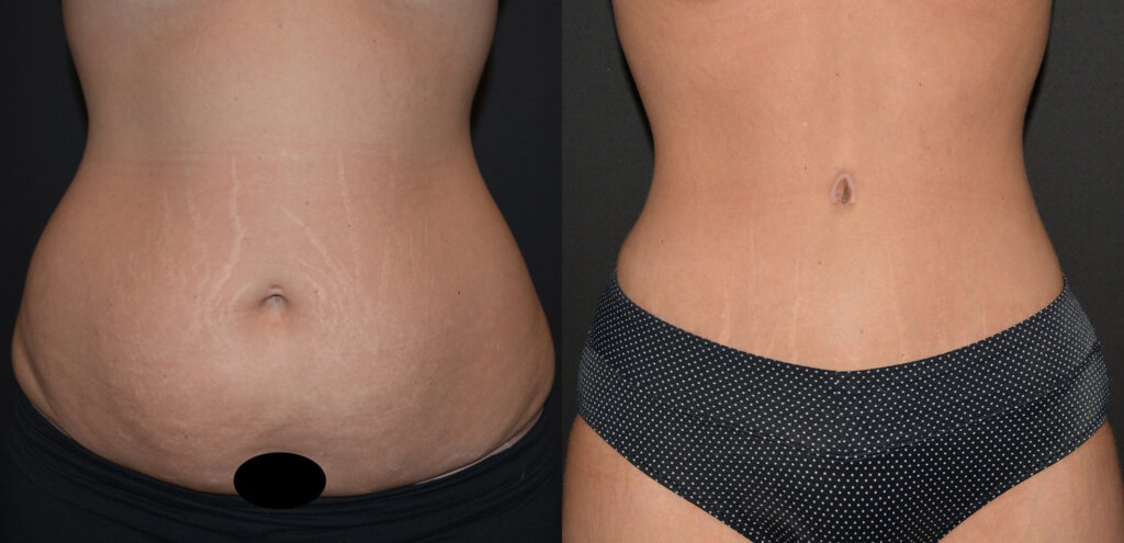 Tummy Tuck Before and After Photo by Craig Fournier MD in Albany, NY