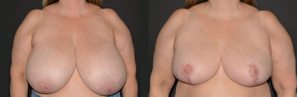 Breast Reduction by Dr. Craig Fournier
