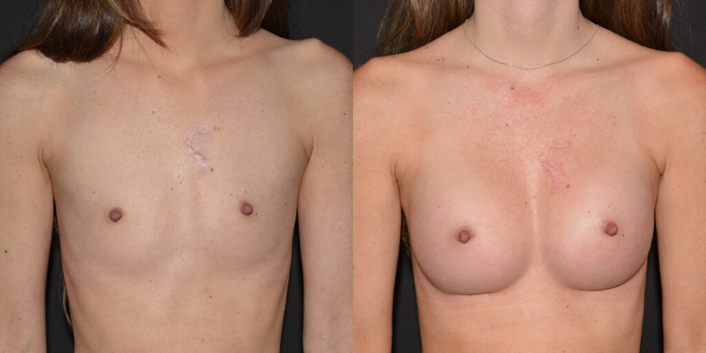 Breast Augmentation Before and After Photo by Craig Fournier MD in Albany, NY