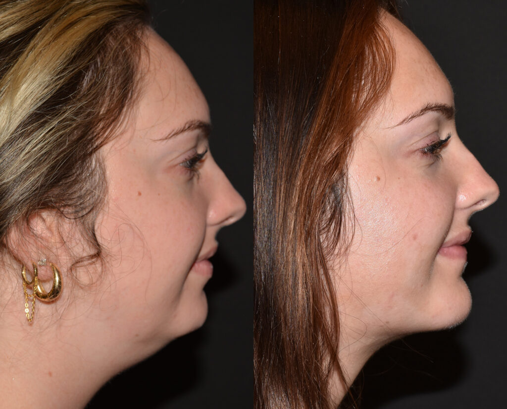 Chin Augmentation Before and After Photo by Craig Fournier MD in Albany, NY