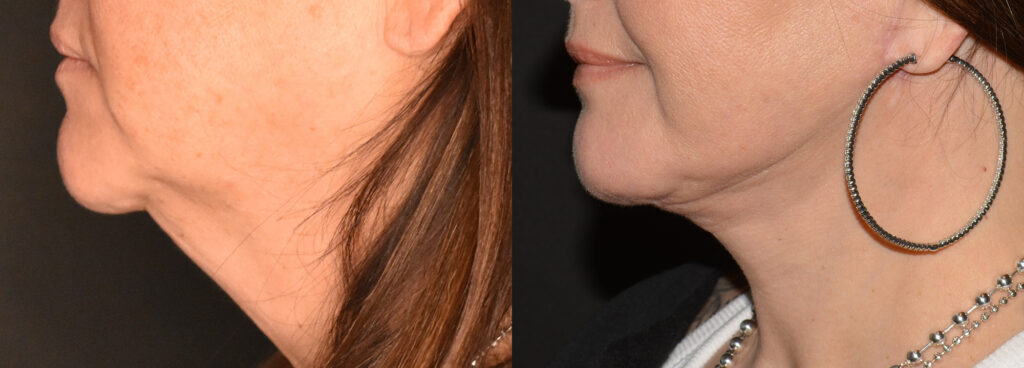Neck Lift Before and After Photo by Craig Fournier MD in Albany, NY